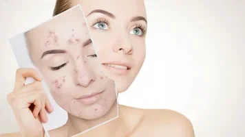 Top Tips on How to Get Rid of Dark Spots on Face Naturally