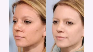 Discover How to Remove Moles from Face Naturally at Home